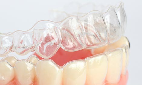 Durchsichtige Schienen auf einem Zahnmodell